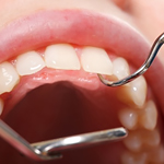 Periodontal Treatment