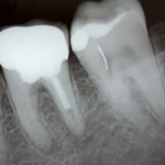 Root Canal Therapy