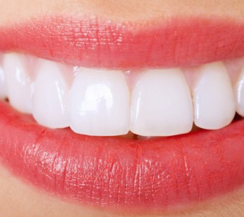 Good News About Porcelain Veneers